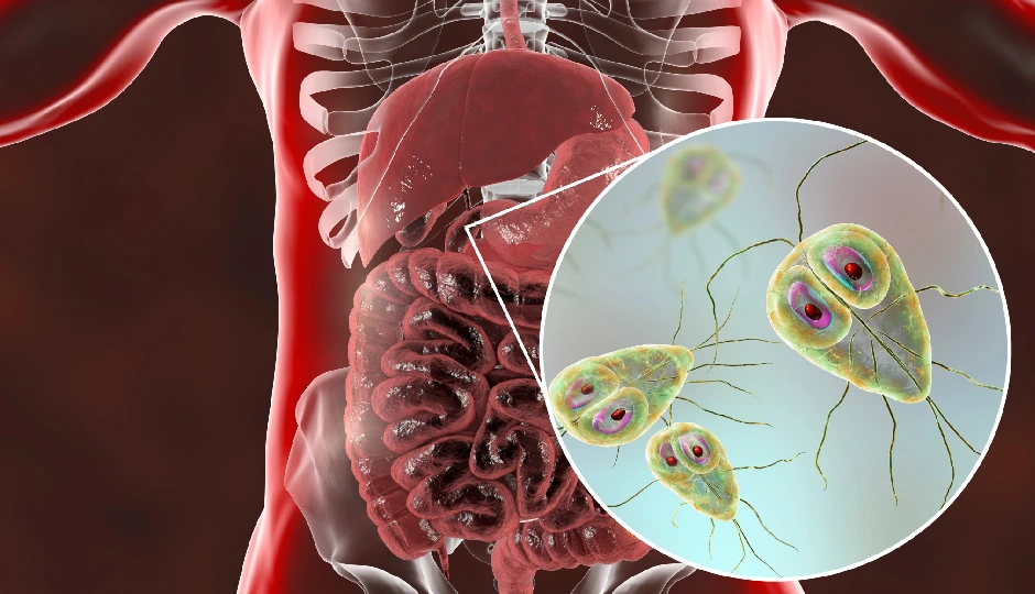 10 Effective Home Remedies for Treating Giardiasis