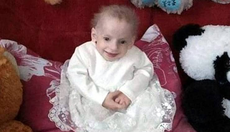 girl,8 year old girl,anna sakidon died,progeria,weird news