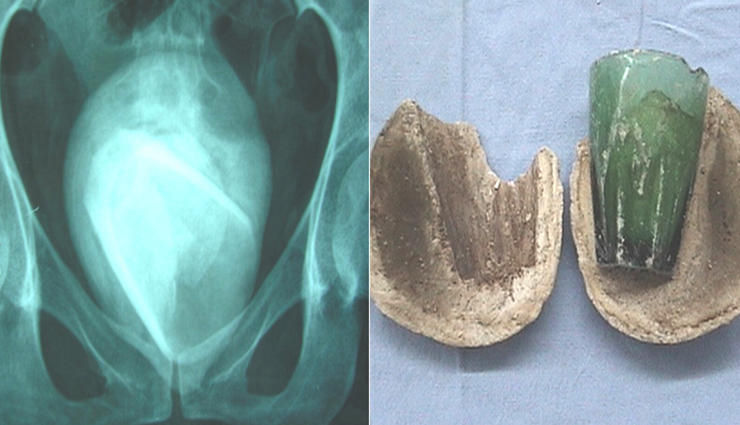 महिला के प्राइवेट पार्ट में दर्द होने का कारण जान उड़े डॉक्टर्स के भी होश! मिला कांच का ग्लास 