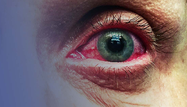 eye problems,eyes care,eye problem,blurred vision,lazy eye,diabetic retinopathy,cataract,glaucoma,blepharitis,crossed eyes,Health