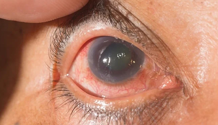 10 Natural Ways To Treat Glaucoma Symptoms