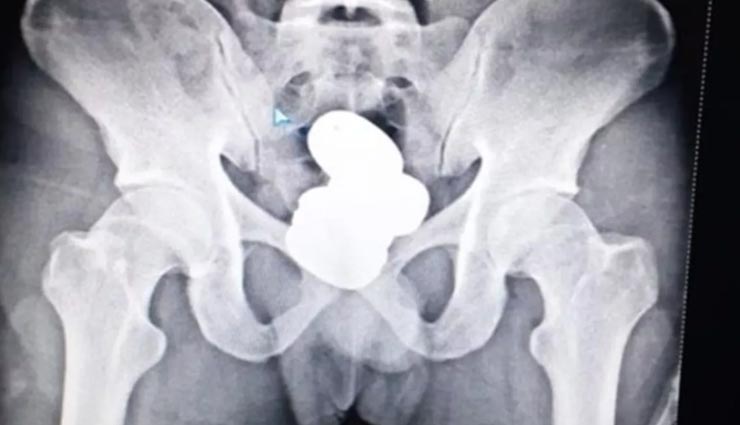 तस्करी के लिए बनाया 42 लाख के सोने का बूरा, शरीर में छुपाया ऐसी जगह जो सोच से परे weird new,s weird incident,gold smuggling,imphal