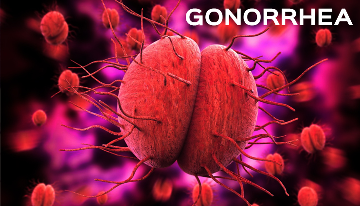 9 Best Remedies For Gonorrhea