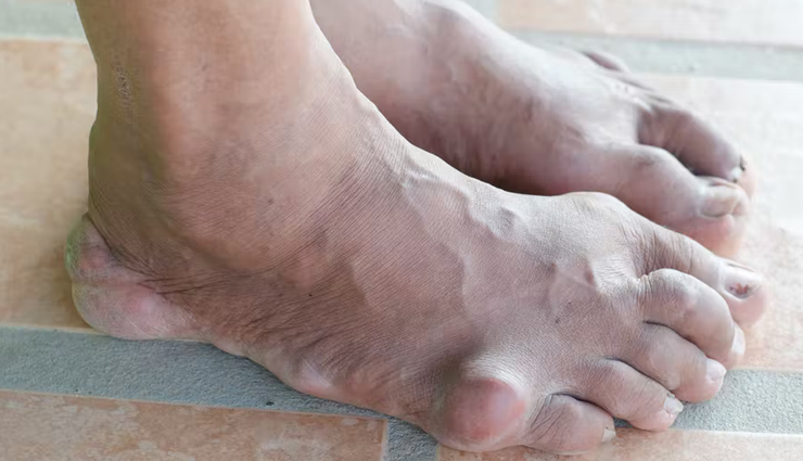 5 Essential Oils That are Helpful in Treating Gout