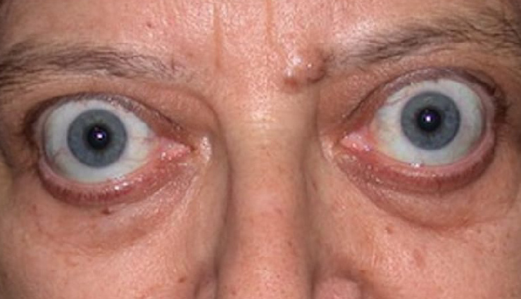 8 Effective Home Remedies To Manage Graves' Disease