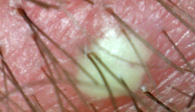 scalp scabs treatment,treating scabs on the scalp,get rid of scalp scabs,home remedies for scalp scabs,scalp care tips,scab removal methods,scalp health advice,healing scalp sores,natural remedies for scalp scabs,preventing scalp scabs