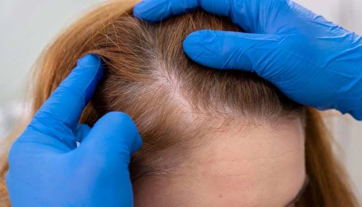 10 Must Try Home Remedies for Hair Regrowth