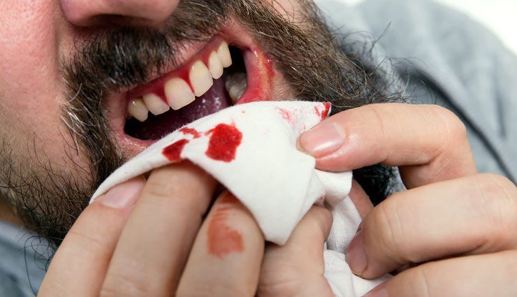 gum bleeding,home remedies,home remedies for gum bleeding,tips to treat gum bleeding,Health tips,fitness tips