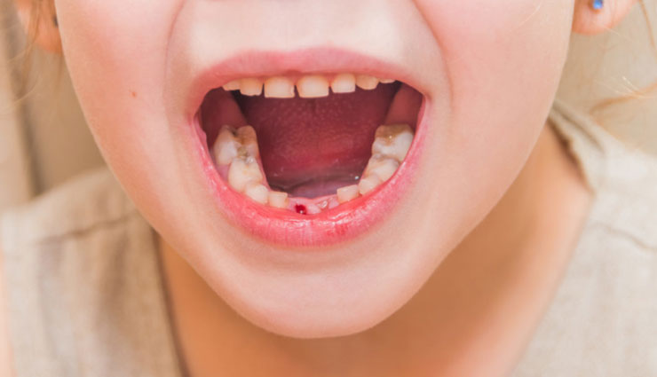 gum bleeding,home remedies,home remedies for gum bleeding,tips to treat gum bleeding,Health tips,fitness tips