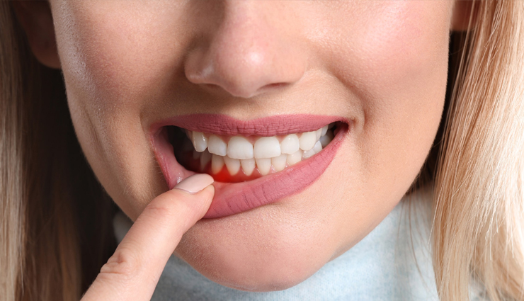 10 Home Remedies You Can Try To Maintain Healthy Gums