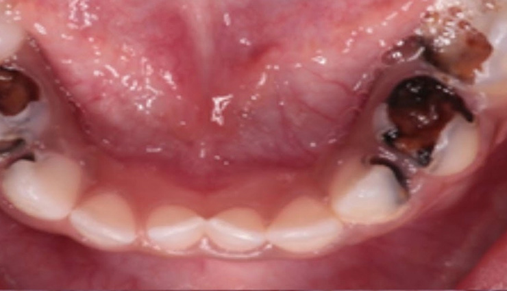 old-age dental problems,common dental issues for seniors,dry mouth solutions for elderly,missing teeth remedies,gum disease prevention for seniors,fungal infections in elderly,oral care tips for older adults,managing dental health in seniors,geriatric dental care tips,dental health for elderly