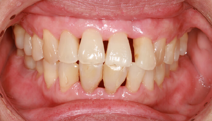 proper tooth brushing duration,dental health tips,avoid overbrushing,two-minute brushing rule,gum recession prevention,enamel erosion risks,soft tissue damage from brushing,tooth sensitivity prevention,how often to brush teeth,dental care advice,oral hygiene tips,brushing technique importance,tooth sensitivity management,dental health recommendations,importance of balanced brushing,preventing dental issues,enamel protection strategies,brushing frequency guidelines,tooth brushing duration limits,oral health preservation