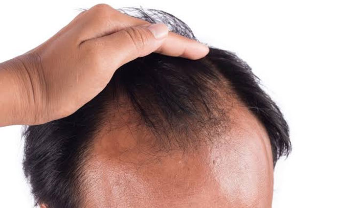 hair baldness,home remedies for hair baldness,natural treatment,hair care tips,beauty tips,skin care tips