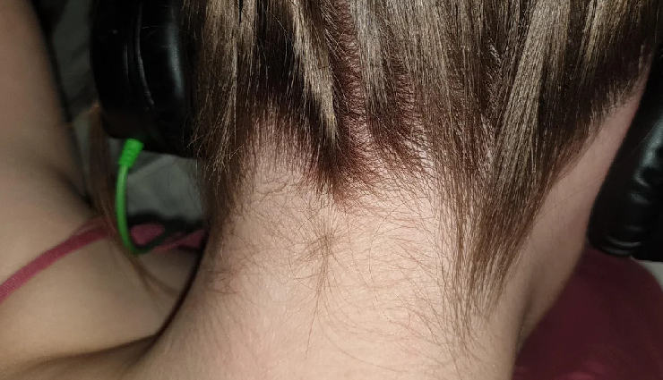 neck acne,acne vulgaris,home remedies,skincare,benzoyl peroxide,tea tree oil,apple cider vinegar,aloe vera,honey and cinnamon mask,clean hair,non-comedogenic products,hydration,diet,lifestyle modifications,severe acne,antibacterial properties,anti-inflammatory properties,hormonal changes,excess oil production,blackheads,whiteheads,cystic acne,gentle cleansing,non-irritating products,skin health