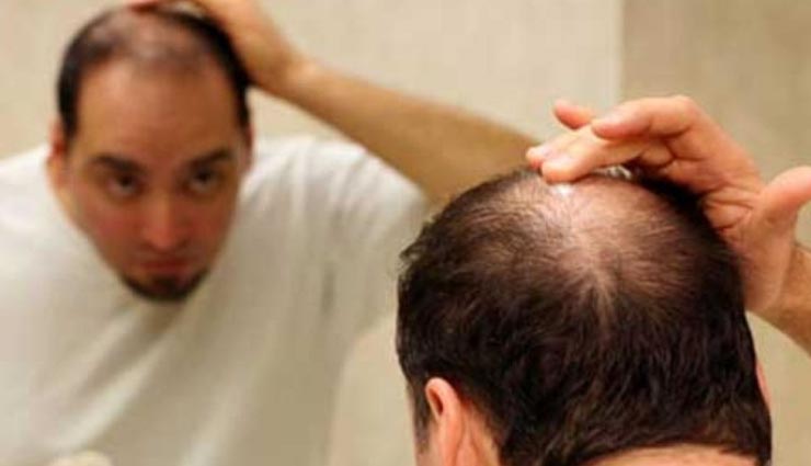 बाजार के महंगे प्रोडक्ट्स की जगह करें इस सस्ते नुस्खे का इस्तेमाल, दूर होगी गंजेपन की समस्या
