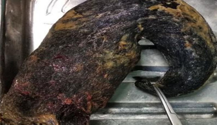 जयपुर : महिला के पेट से डॉक्टरों ने निकाला  बालों का 1 किलो का गुच्छा, 10 सालों से खा रही थी