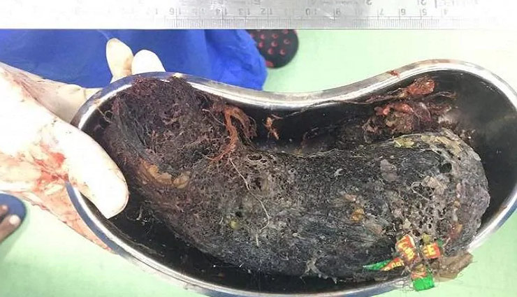 tamilnadu,half kg hair,empty shampoo packets,remove,girl,stomach pain,weird news