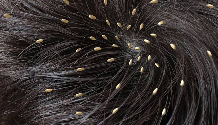 Home Remedies to Get Rid of Hair Lice