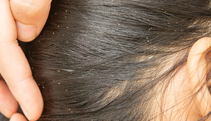मॉनसून के दौरान पनपने लगती हैं बालों में जुओं की समस्या, इन तरीकों से पाएं राहत 