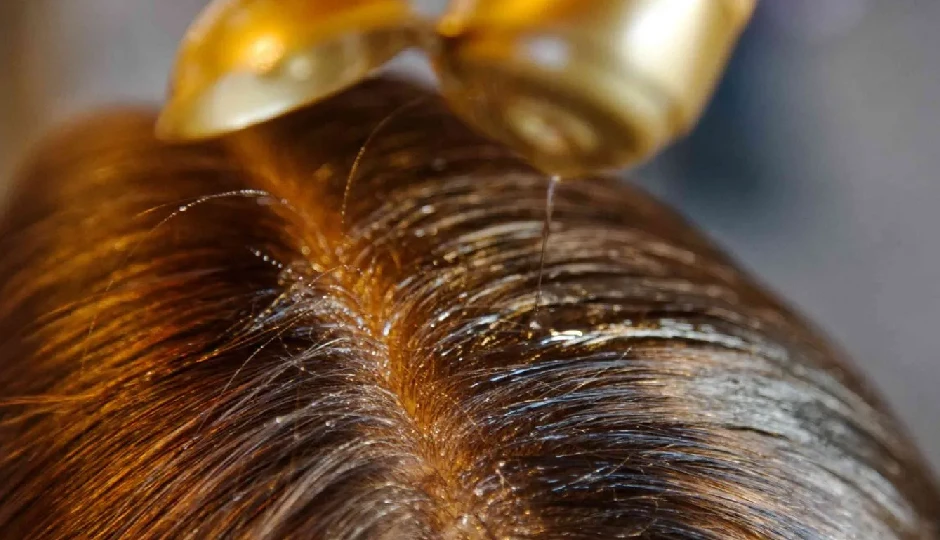 सरसों के तेल में ये 5 चीजें मिलाएं, बालों का झड़ना होगा कम, जानें तरीका