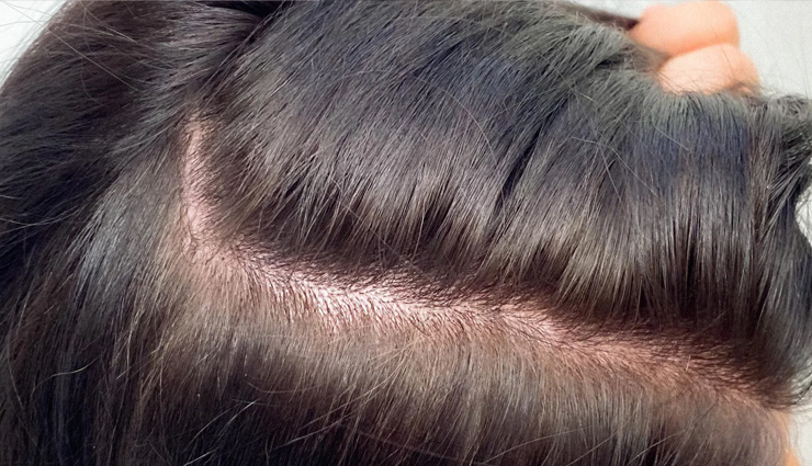 onion hair oil benefits,onion oil for hair growth,natural hair remedies,onion oil for dandruff,prevent hair fall with onion oil,onion hair oil for gray hair