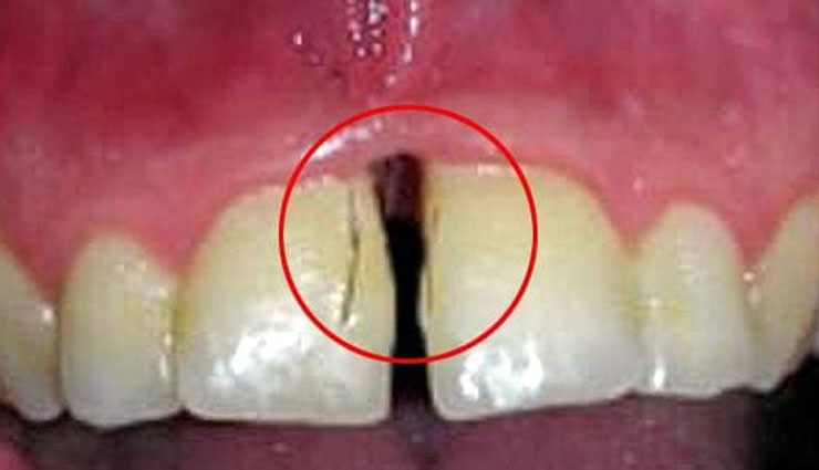woman,hair,gums,teeth,bizzare,surprising,italian,pcos,polycystic ovary syndrome,testosterone,weird news