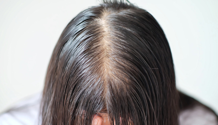 6 Remedies To Treat Hair Thinning at Home