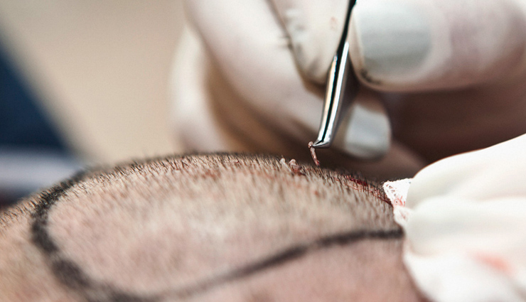 Tips To Follow Before Hair Transplant Surgery