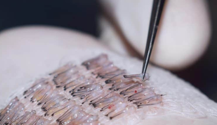 hair transplant preparation,preparing for hair transplant,tips for successful hair transplant,smooth hair transplant procedure,preoperative hair transplant tips,hair transplant readiness,getting ready for hair transplant,planning for successful hair transplantation,steps for a successful hair transplant,optimizing hair transplant results