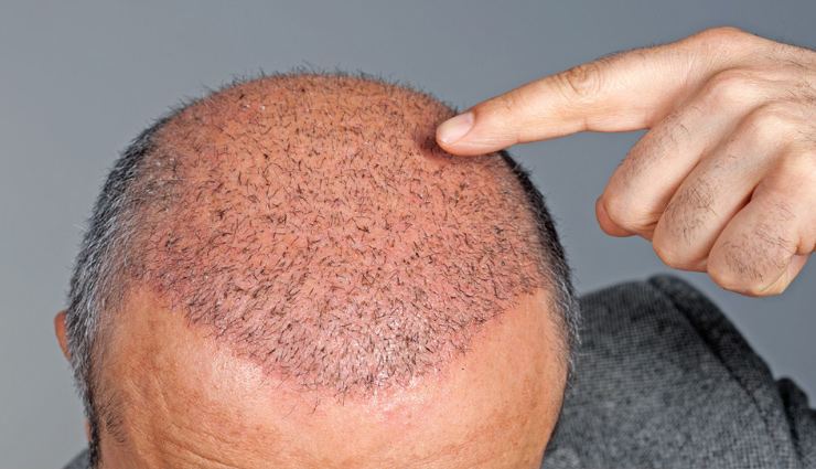 hair transplant surgery,before hair transplant surgery,tips for hair transplant surgery,beauty tips,hair care tips