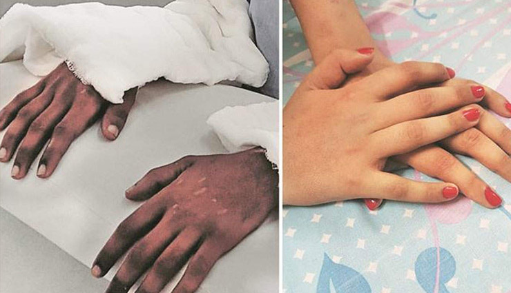 skin tone changed after hand transplant,pune hand transplant case,hand transplant surgery,hand transplant case,changing hands of shreya,news