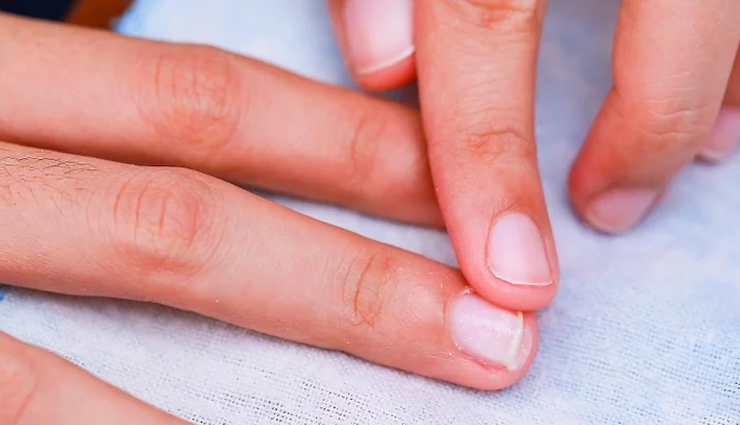 tips to treat and avoid hangnails,hangnails,nails care tips,beauty tips,skin care tips,summer tips