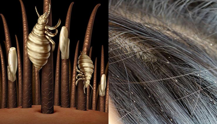 गर्मियों में जुएं बनती हैं बड़ी परेशानी, इन उपायों से मिलेगा छुटकारा