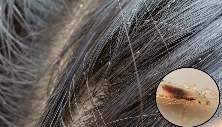 5 Most Effective Home Remedies To Get Rid of Head Lice 