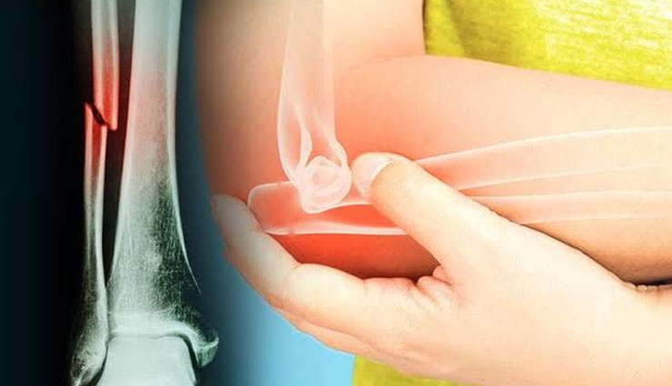कहीं आपको लगी चोट से हड्डी तो नहीं टूट गई, इन संकेतों से लगाए इसका पता 