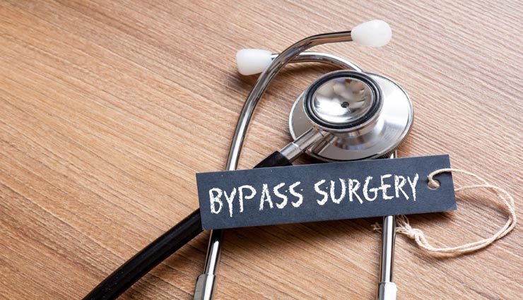 बहुत कम लोग जानते हैं हार्ट बाईपास सर्जरी से जुड़ी ये जरूरी बातें, यहां जानें सबकुछ