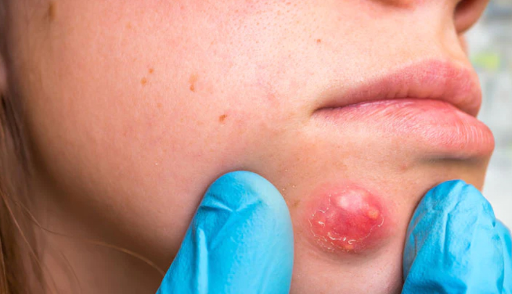 5 Natural Remedies To Cure Heat Boils on Face
