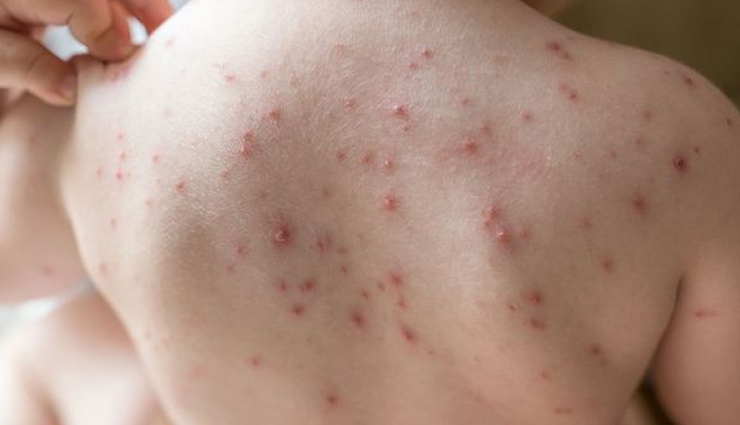 8 Home Remedies To Treat Heat Lumps