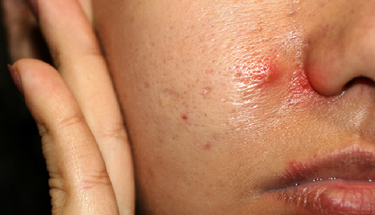 10 Home Remedies To Treat Heat Pimples Quickly