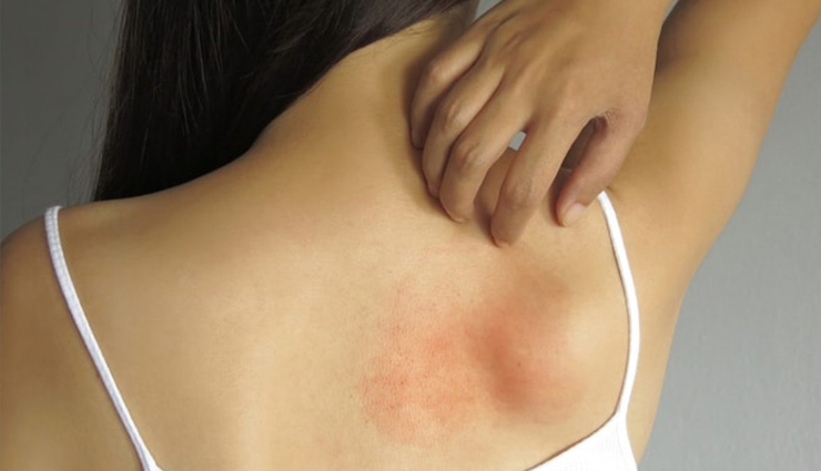 skin infection,skin problems,monsoon problems,allergies,rashes,tips to treat skin allergies and rashes,monsoon allergies,beauty tips