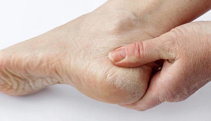 beauty tips,beauty tips in hindi,home remedies,cracked heels treatment