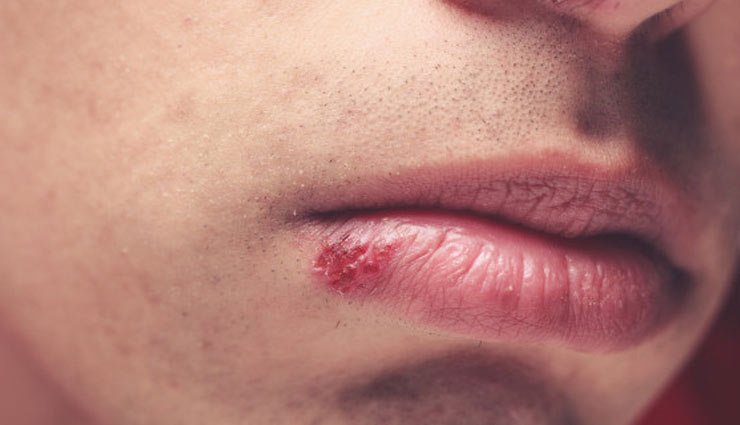 herpes,home remedies,home remedies to treat herpes,Health tips,fitness tips