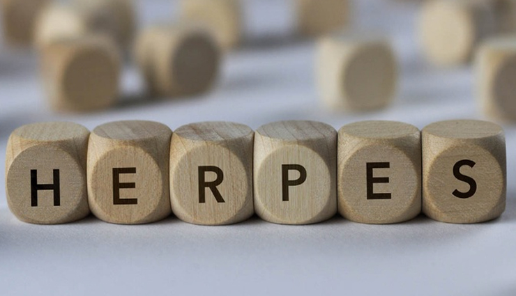 10 Home Remedies To Treat Herpes