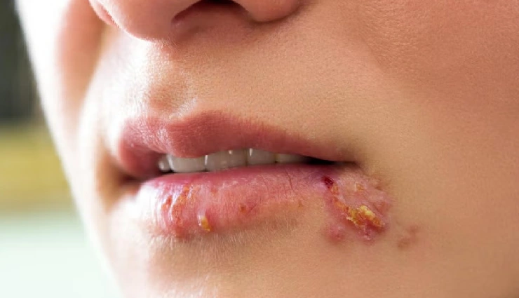 6 Home Remedies To Treat Genital and Oral Herpes