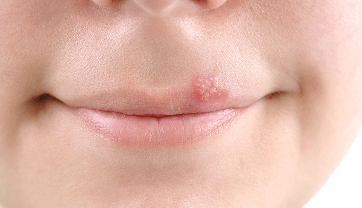 herpes,home remedies,home remedies to treat herpes,Health tips,fitness tips