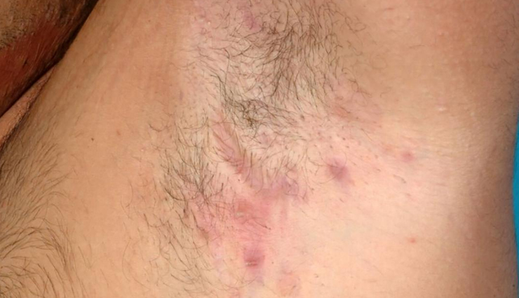 underarm allergies,causes of underarm allergies,allergy,underarm allergies remedies,skin,skin care tips,beauty,beauty tips