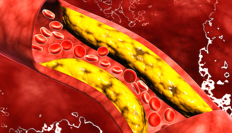 बैड कोलेस्ट्रॉल बढ़ने का ये संकेत दिखते ही हो जाएं सतर्क, नहीं तो जाना पड़ सकता है अस्पताल high cholesterol,cholesterol signs,cholesterol risk factors,cholesterol effects on the body,cholesterol symptoms,cholesterol cramps,peripheral artery disease and cholesterol,hypercholesterolemia,cholesterol levels,ldl cholesterol,hdl cholesterol,cholesterol management,cholesterol reduction,cholesterol-lowering foods,elevated cholesterol signs,cholesterol warning signs,high cholesterol indicators,cholesterol-related symptoms,silent cholesterol symptoms,cholesterol and fatigue,cholesterol and dizziness,cardiovascular risks of high cholesterol,heart disease and cholesterol,atherosclerosis and cholesterol,stroke risk and high cholesterol,cholesterol impact on arteries,organ damage from high cholesterol,cholesterol medications,lifestyle changes for cholesterol control,exercise for cholesterol management,diet for high cholesterol,preventing peripheral artery disease,medications for peripheral artery disease