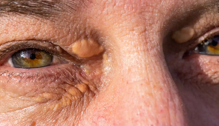 कोलेस्ट्रॉल जब बढ़ जाए हद से ज्यादा तो हाथों-पैरों की उंगलियों पर दिखते हैं ये लक्षण, नजरअंदाज करना पड़ सकता है महंगा cholesterol symptoms extremities,warning signs of high cholesterol,cholesterol effects on fingers and toes,recognizing cholesterol-related symptoms,signs of elevated cholesterol levels,cholesterol symptoms in hands and feet,importance of detecting cholesterol symptoms,cholesterol indicators on fingers and toes,identifying cholesterol warning signs,cholesterol-related symptoms awareness