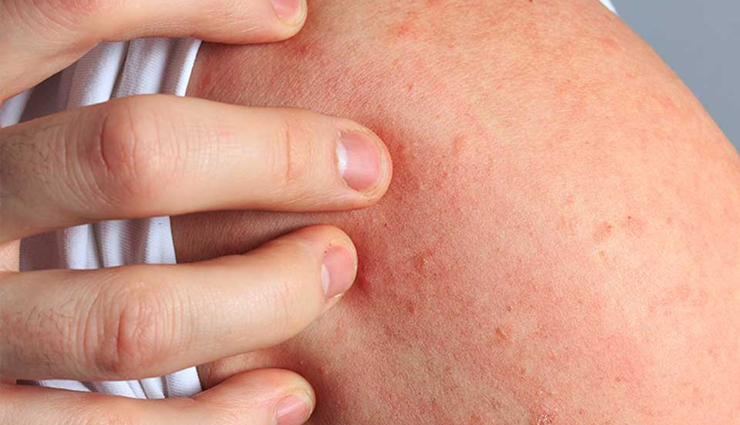 hives,hives treatment,home remedies to treat hives,hives treatment at home,Health,Health tips