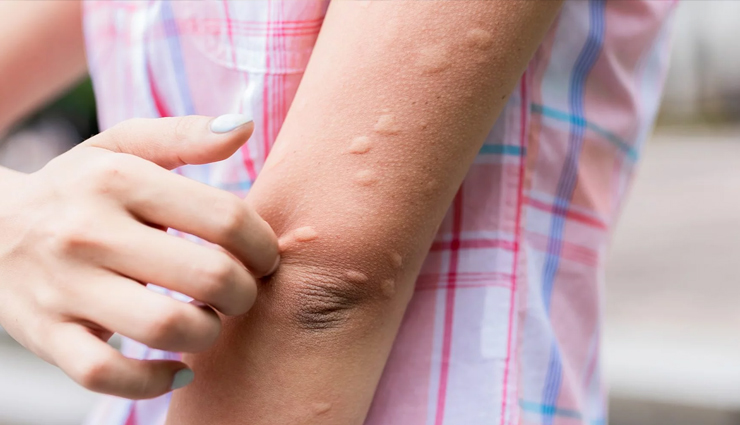 6 Natural Remedies To Get Rid of Hives